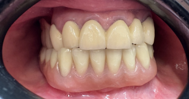 korony porcelanowe oraz proteza szkieletowa z zasuwami w górnym łuku oraz proteza teleskopowa w dolnym łuku