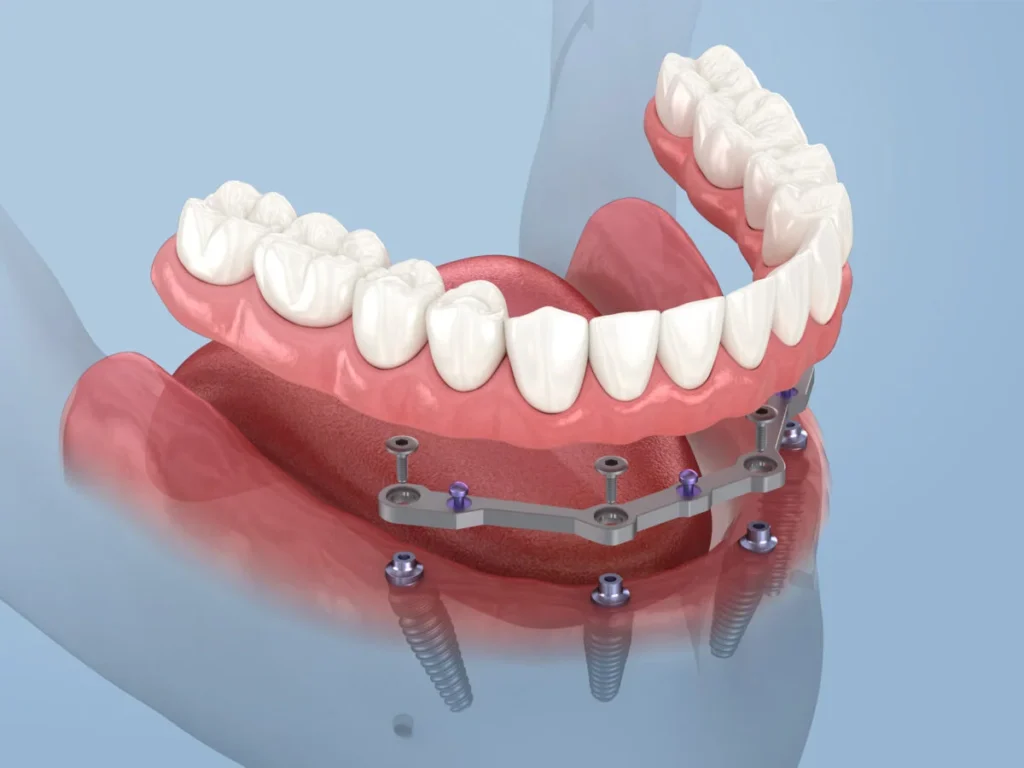 całkowite bezzębie - odbudowa na implantach