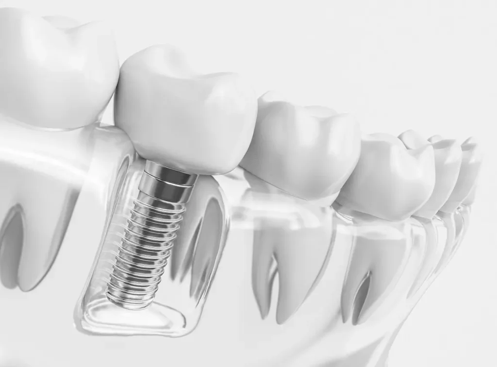 osteointegracja implantów
