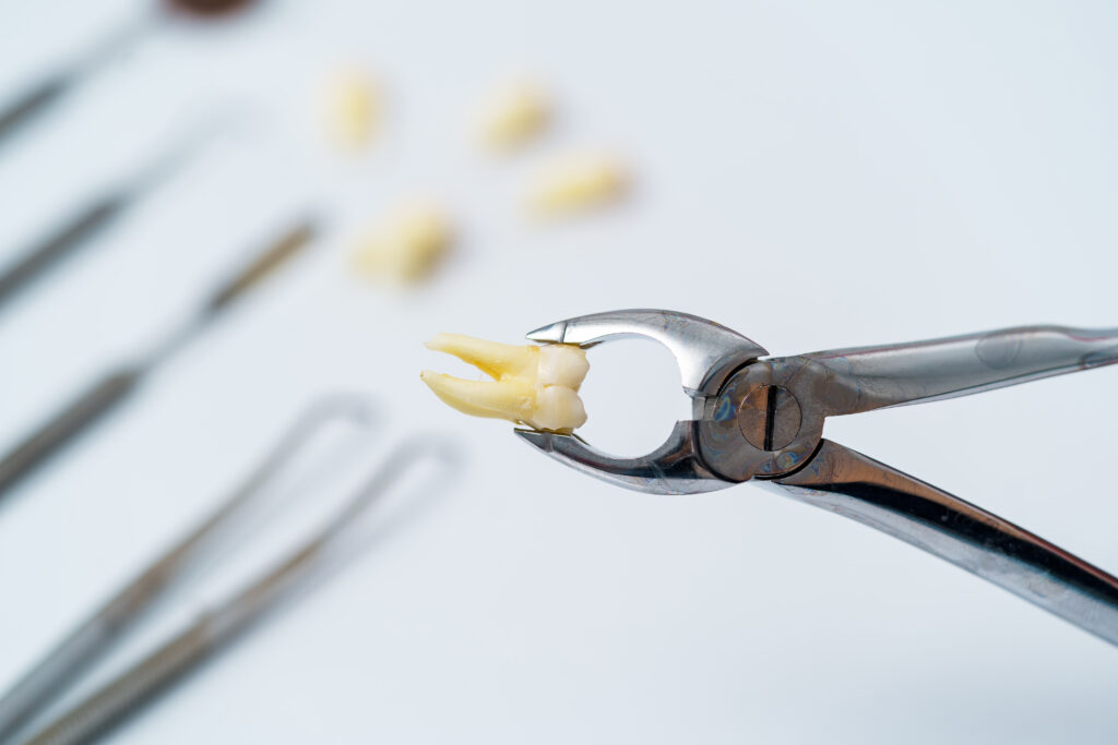 Ekstrakcja zęba Katowice - Dłucik Dental Clinic